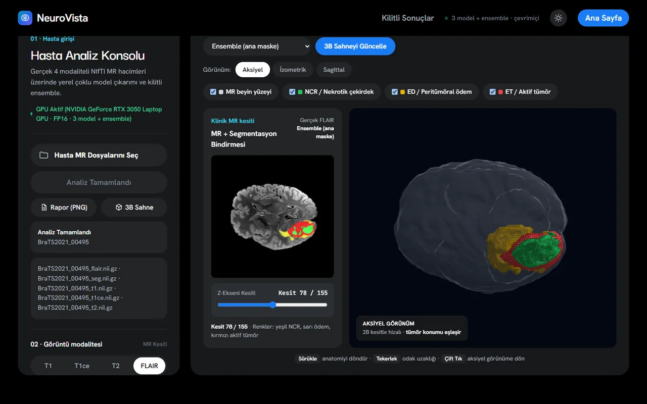 The 3D scene with the segmented tumour sub-regions drawn as surfaces inside the brain.